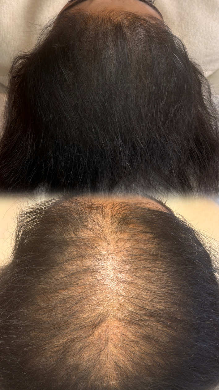 Vorher / Nachher — Haarverdichtung