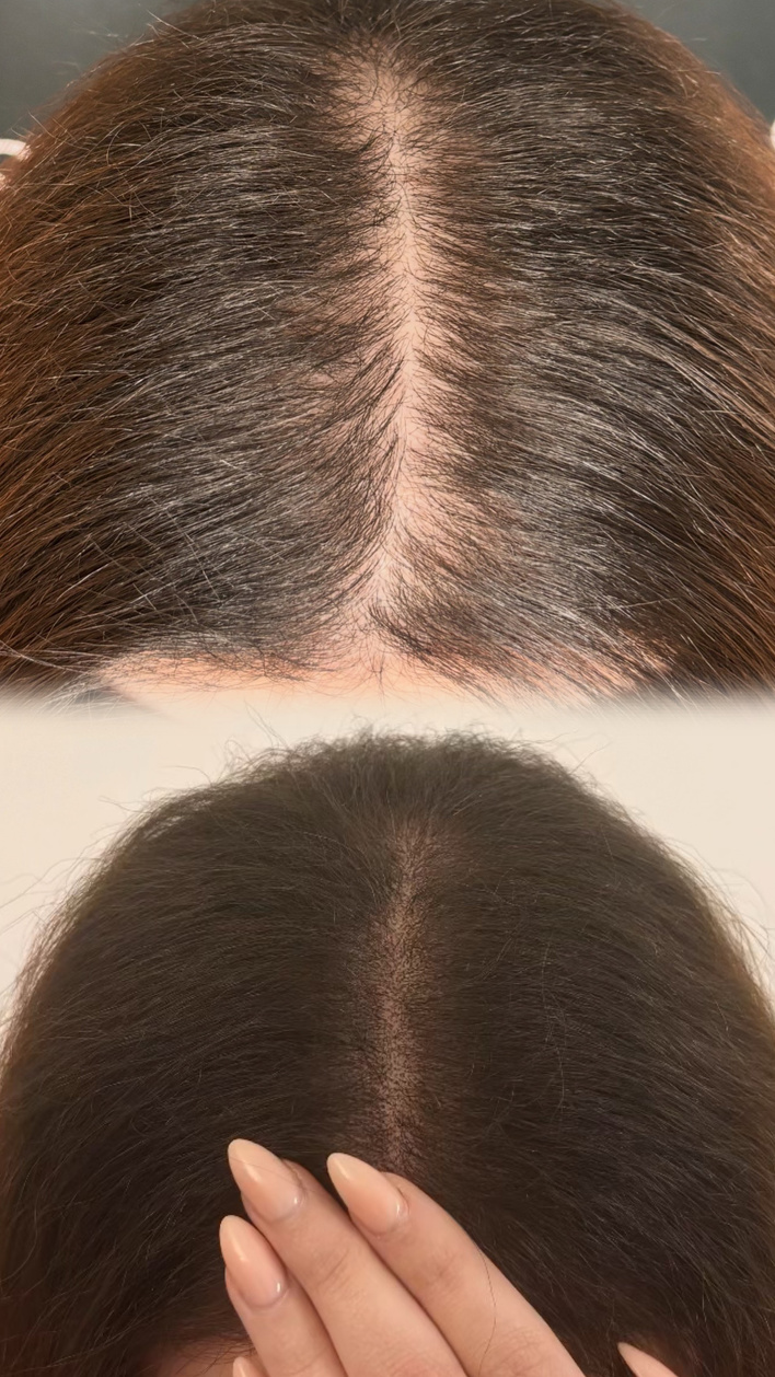 Nahaufnahme — Scheitel mit sichtbarer Haarlinie