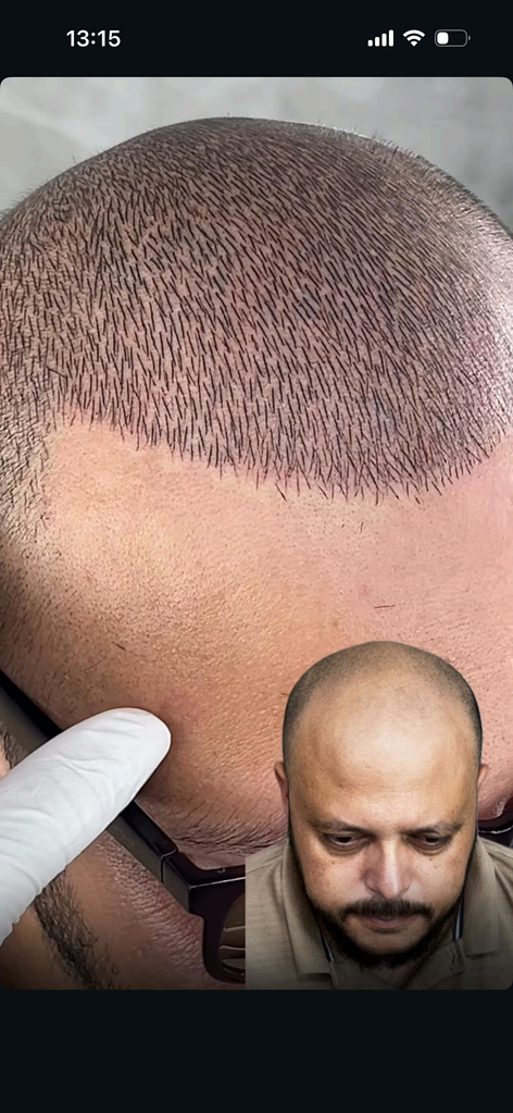 Nahaufnahme einer behandelten Haarlinie